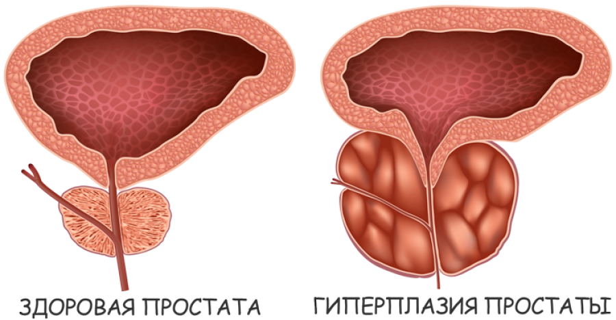 простата